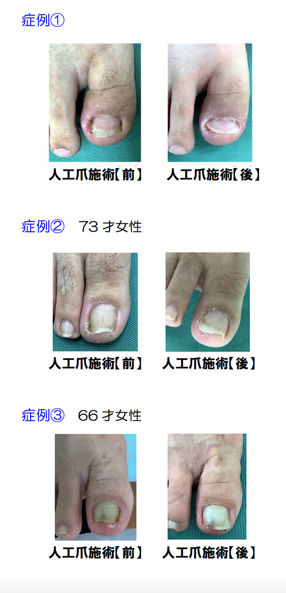 巻き爪 陥入爪 おぎはら皮ふ科 巻き爪 陥入爪 おぎはら皮ふ科